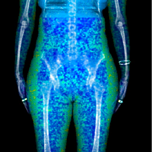 Body composition dexa scan showing distribution of fat